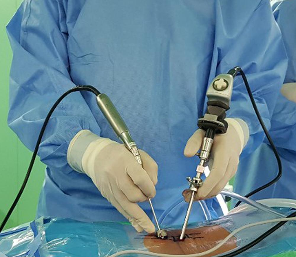 Spinal Endoscopic Surgery